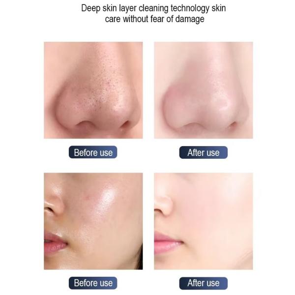 Hydra Dermabrasion Facial Machine Oxygen Facial Beauty Machine For Sales