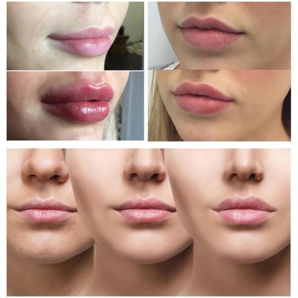 HA лицевые морщины Juvederm Ultra 4 Lips Ultra3 Кожные наполнители для линий смеха
