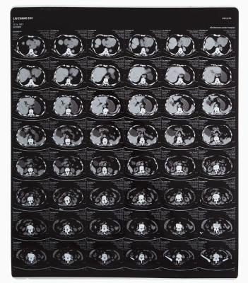 Excellent Flexibility Medical X Ray Film For Laser Image Printer Processor