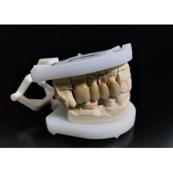 Durable Porcelain Fused To Metal Crown Customized Shade Matching Long Lasting Dental Restoration Solution