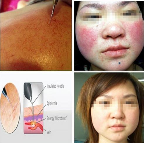 Professional spider vein removal equipment/vascular removal/rf principle