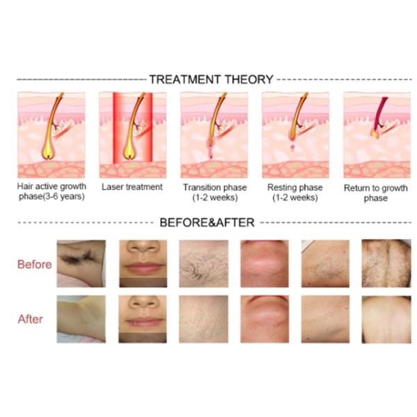 Anti Wrinkle 808nm 810nm Diode Laser 600w 10 Bars 10 Million Shots