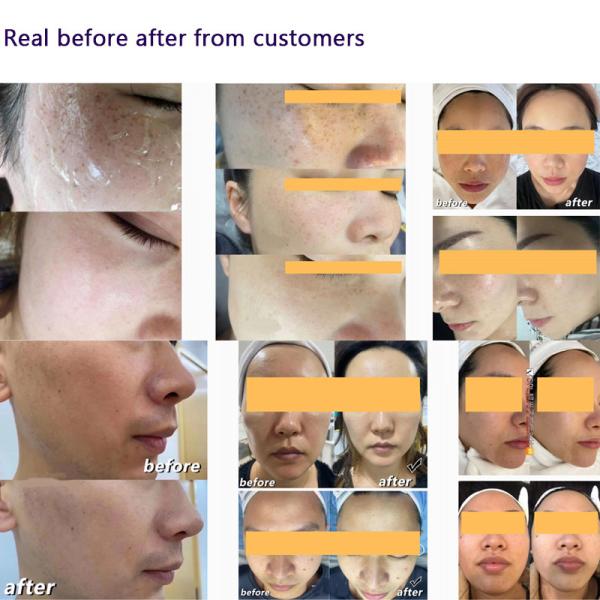 Длина волны машины 1300нм 550нм 500нм удаления волос лазера ИПЛ подмолаживания кожи