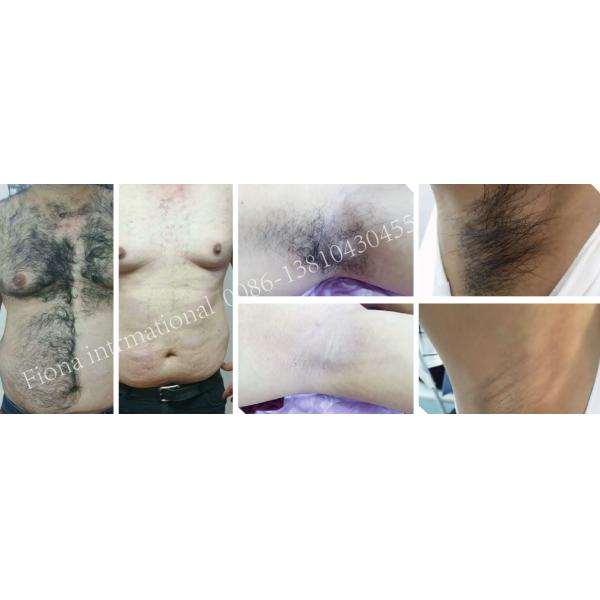OPT SHR Laser Machine , Speed Skin Rejuvenation Painless Hair Removal Machine