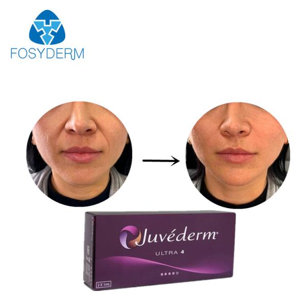 A cruz de Juvederm ligou o enchimento cutâneo ácido hialurónico Allergan ultra 4