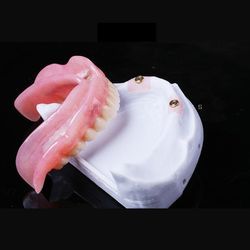 Ball-Cap Implant Overdenture Offers Excellent Stability and Retention Suitable for Elderly Patients Lab Prices