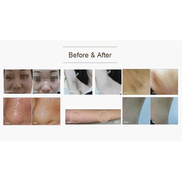 High Efficiency Ipl Laser Hair Removal Device Skin Lifting White / Grey Color