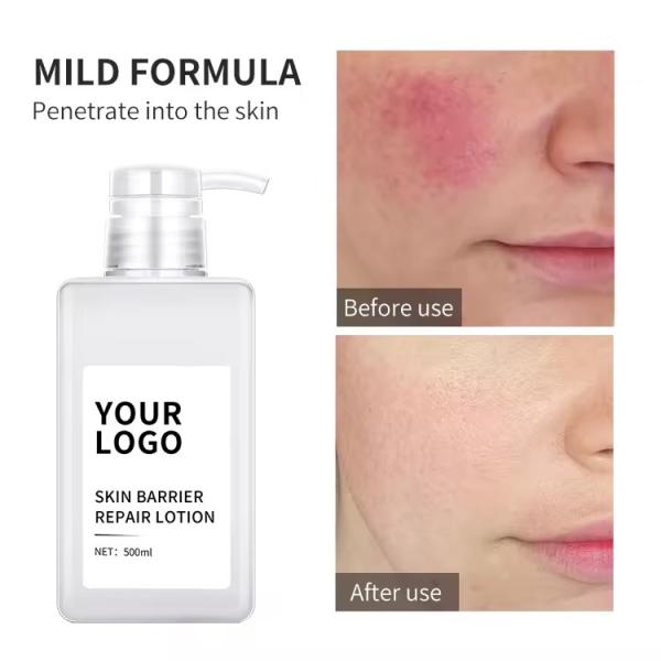 Glycyrrhiza Glabra Loção Facial Anti Acne Barriera Loção Reparação Calmante Sensível