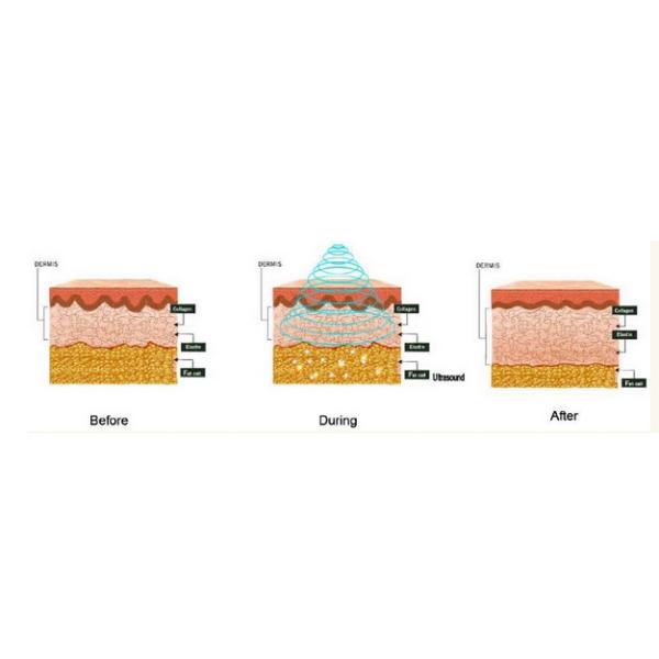 New designed RF+ Vacuum+Ultrasonic Cavitation Body Slimming Skin Lifting Machine