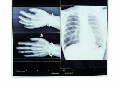 Do calor de alta resolução seco médico do filme de Konida imagem latente de oposição