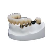 Stabilité forte de couronne de résistance à la corrosion de précision de dentier télescopique dentaire d'attachement