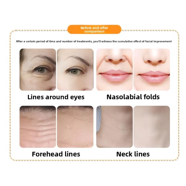 7D HIFU Face And Body Machine , Non Surgical HIFU Skin Tightening Machine