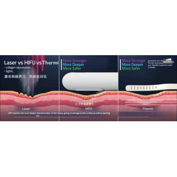 2 in 1 female intimate areal Tigthen RF Radio Frequency Technology Labia Tighten Rejuvenation Device