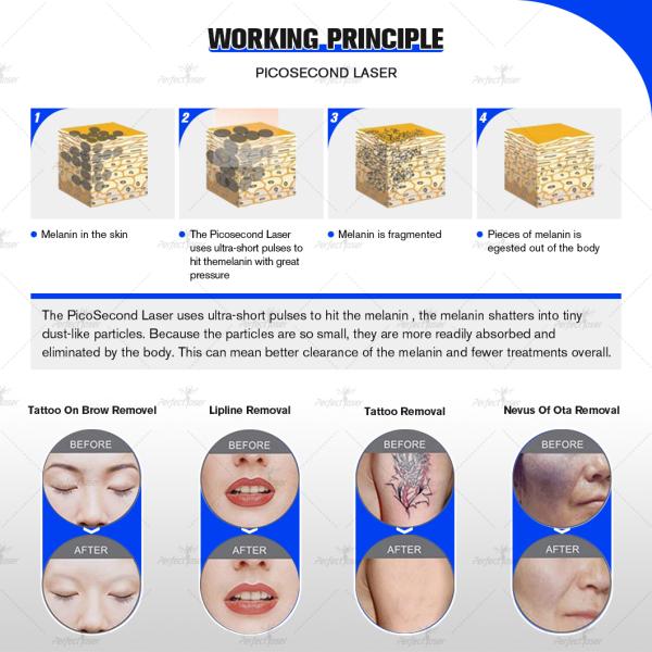 Picosecond Laser 4 Wavelength Tattoo Removal Skin Rejuvenation 530+755+1064+1320nm Q-Switched ND: YAG Machine