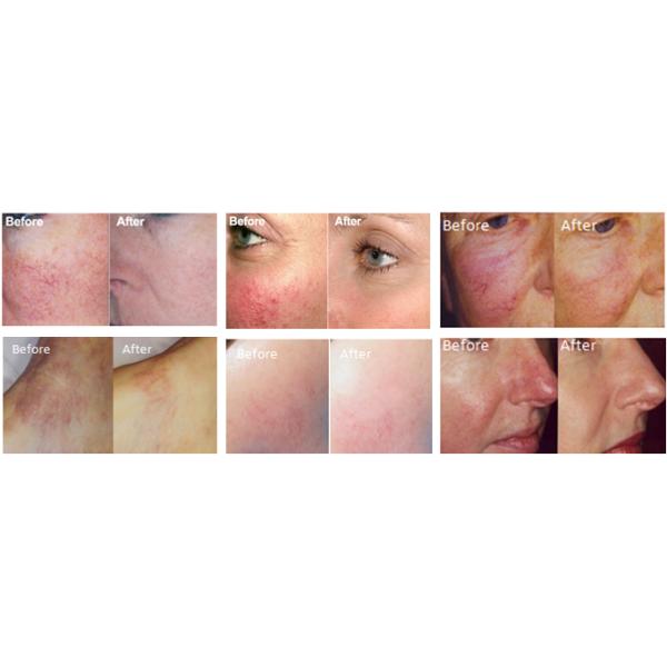 Safe 980 Spider Vein Removal Machine , Diode Laser Equipment For Rosacea Removal