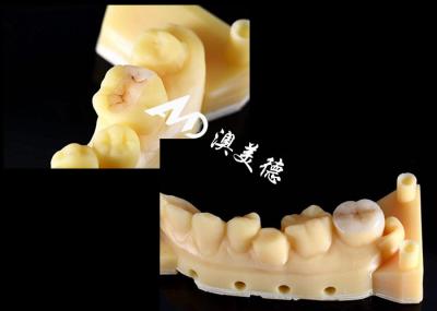 Cor Natural Precisão Inlays Cerâmicos Onlays Dentes Hipoalergênicos