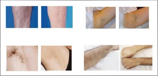 GentleYAG Laser Hair Removal: Precisely Target Individual Hair Follicles With 755nm And 1064nmLong Pulse Laser Nd Yag