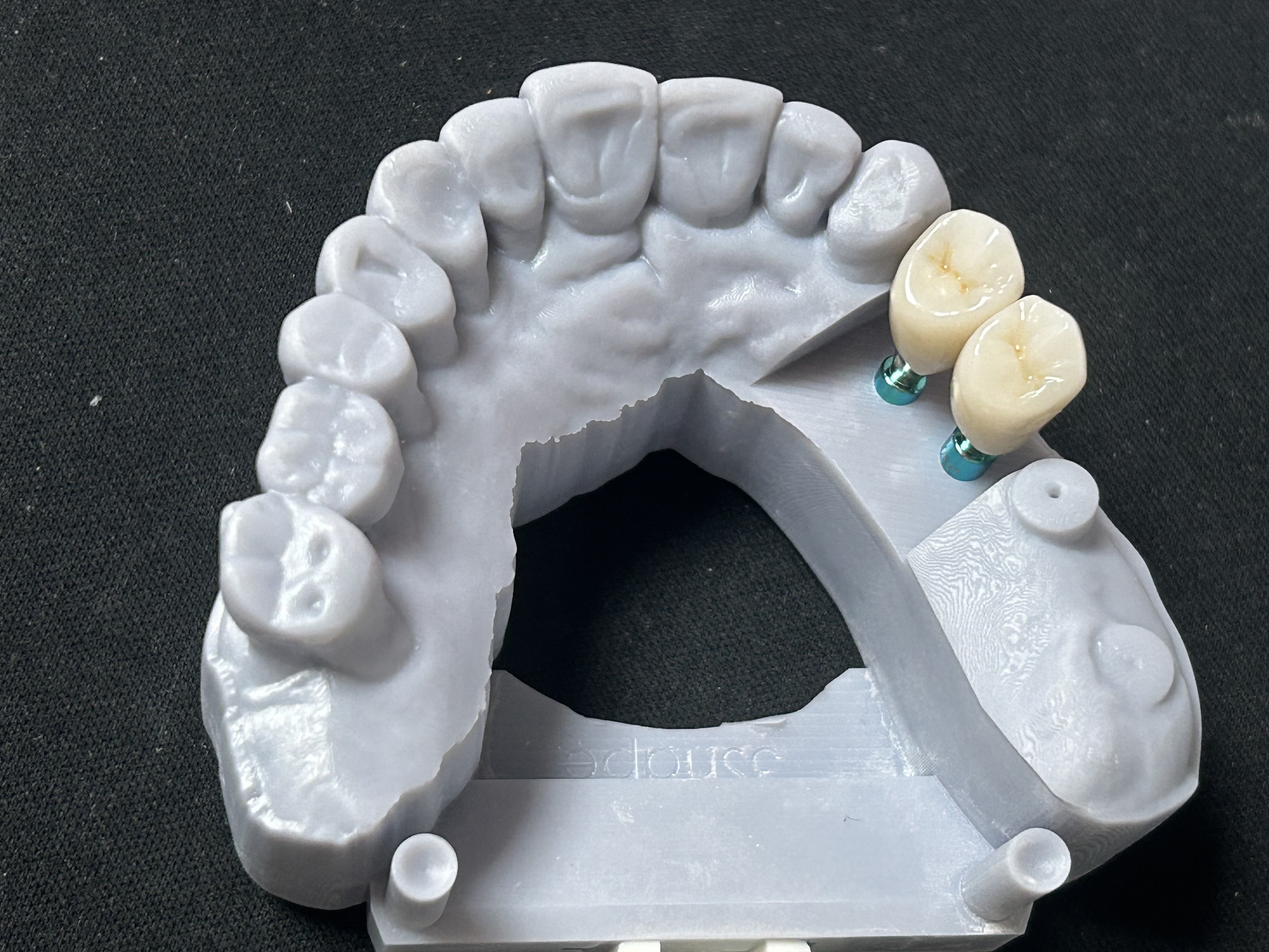 High-Strength Zirconia Implant Restoration with Natural-Looking Appearance and Digital CAD/CAM Manufacturing