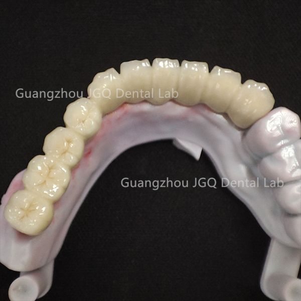 Dental Pfm Crown and Bridge Restorations for Dental Care China Dental Laboratory