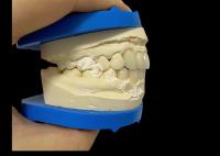 Força imbatível Circônio Dental Coroa Dentária Para Sorrisos Naturais