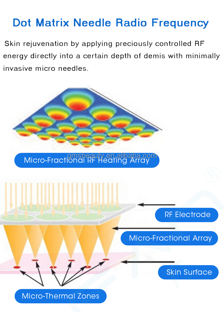 Кожа Resurfacing частичная машина RF Microneedle с холодной терапией инвазионной