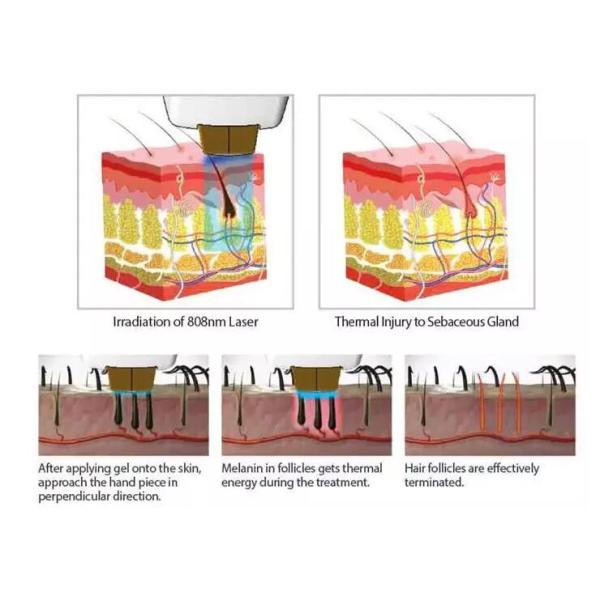 Vertical Medical Salon Laser Hair Removal Machine Non Channel 808nm Type