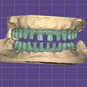 Puente Malo de titanio puro Dentes de marco de metal de plata personalizables
