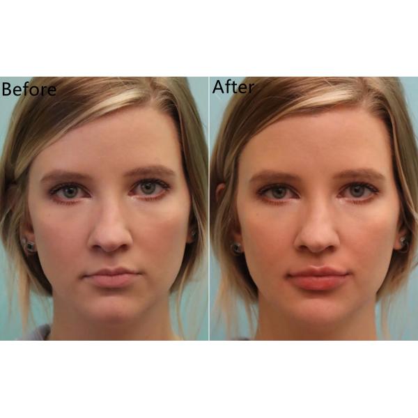 Injectable Dermal Filler Juvederm Voluma Anti Wrinkles For Cheek