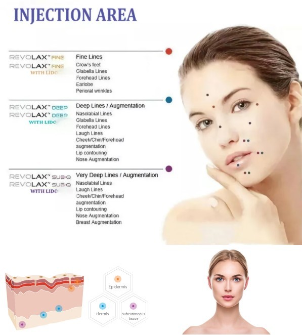 впрыска тела заполнителя натрия 1.1ml Hyaluronic кисловочная дермальная