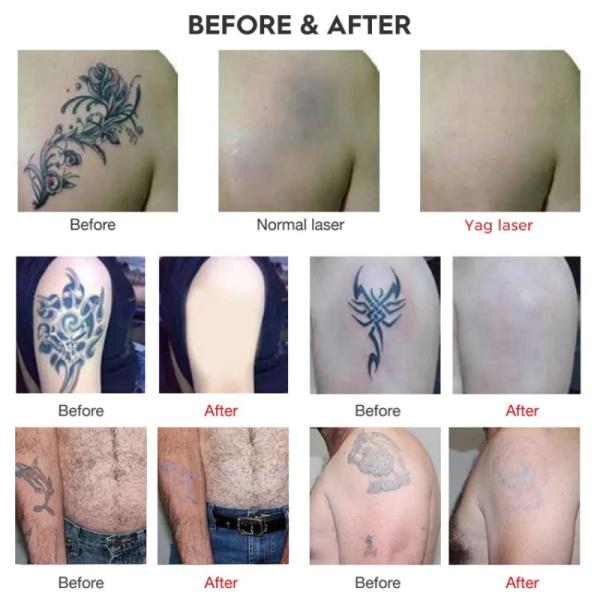 755 1064 532nm ND YAG Laser Tattoo Pigment Removal Device with Professional Pigment Remover Technology and Carbon Peeling