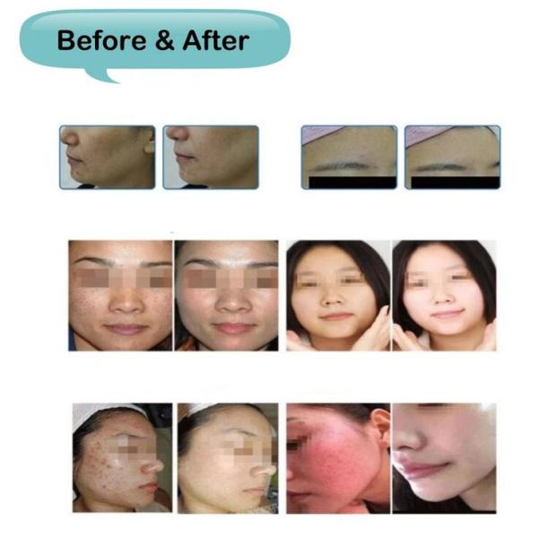 Six In One Hydrafacial Machine For Facial Comprehensive Basic Nursing Care