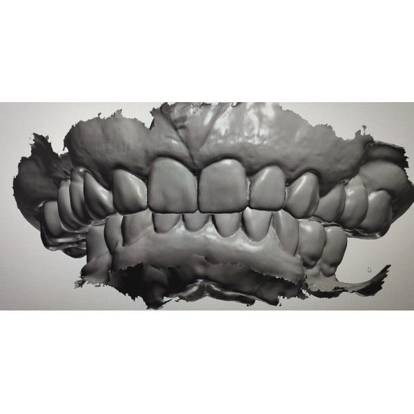 3D Digital Mock Up Teeth Other Dental Products