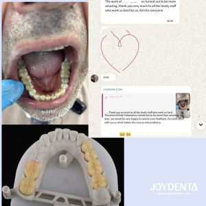 Prothèses en zirconium qui imitent les dents naturelles