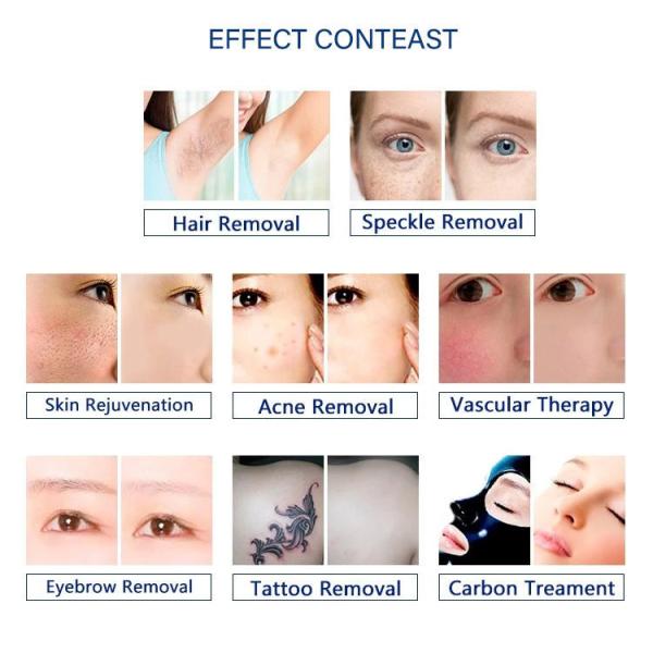 Q Switch Nd YAG IPL Laser Hair Removal Machine 1064nm/532nm/1320nm