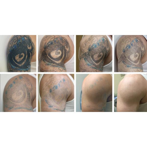 2018 most popular laser beauty machine tattoo studio used 532nm 1064nm PICOSECOND