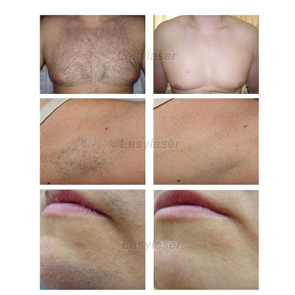 Salon E-Light SHR IPL Laser Hair Removal Machine RF Powerful