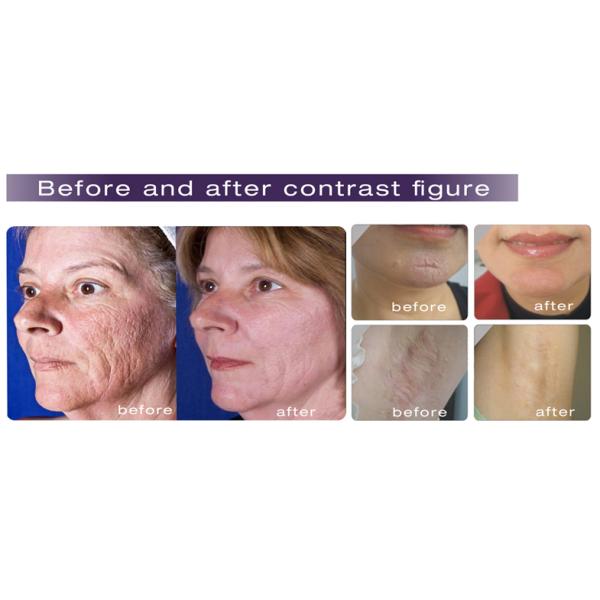 Clinic CO2 Fractional Laser Machine Scar Removal Laser Skin Rejuvenation Machine