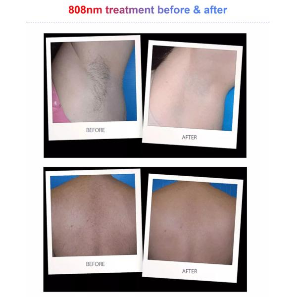 2 In 1 755nm 1064nm Diode Laser Hair Removal System Laser Tattoo Removal Equipment