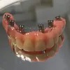 Choose China Dental Implants for Permanent and Reliable Solution to Missing Teeth with Wholesale Prices