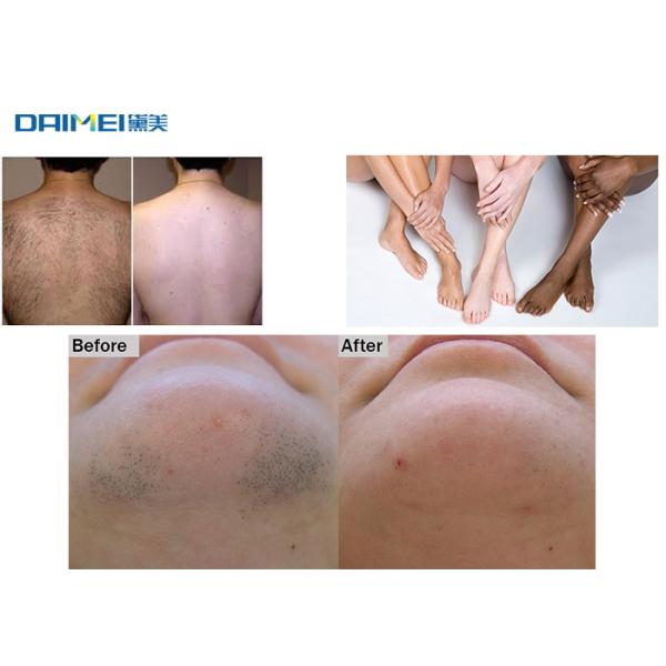 Salon Laser Hair Removal Machine , Permanent Hair Removal Devices Pain Free