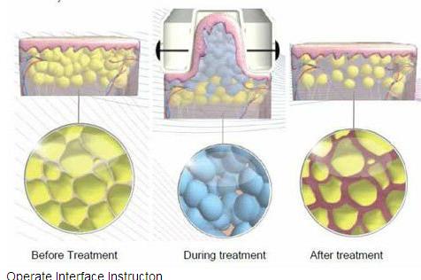 2015 newest cryolipolysis fat freeze body slimming machine for beauty salons