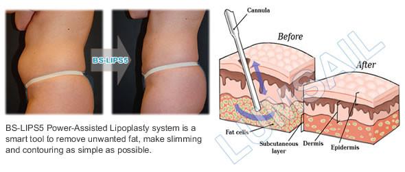 Body Contouring Power Assisted Liposuction Equipment For Body Sculpting Treatments