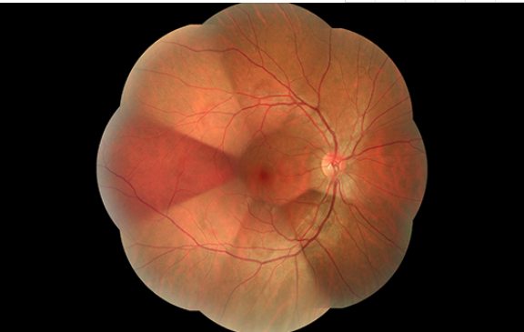Широкий зрачок камеры 2.8mm Fundus поля не Mydriatic отображая область видимости 135°
