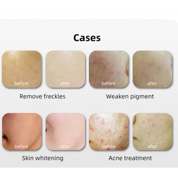 Многофункциональное подмолаживание кожи машины 415nm 640nm терапией света СИД PDT