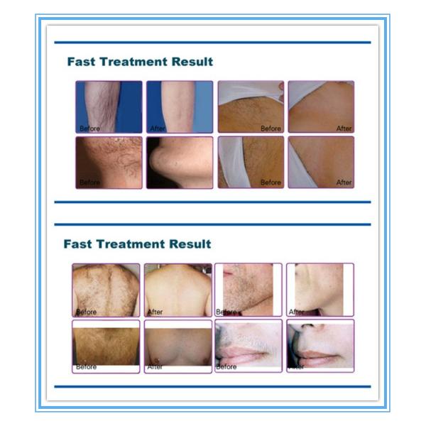 Salon 808nm Diode Laser Hair Removal machine , Laser Tattoo Removal Machine