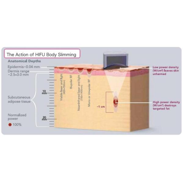 Effective HIFU Skin Tightening Machine  Liposuction 620 shots cartridge