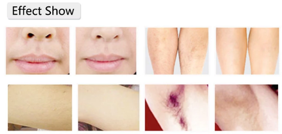 4HZ 808nm Clinic Diode Laser Hair Removal Machine