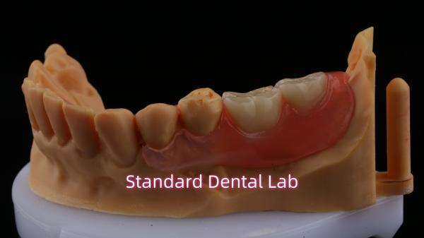 Ace Teeth Rosa/escura TCS Valplast Dentes parciais flexíveis para alta estética Dental 3D Print Model