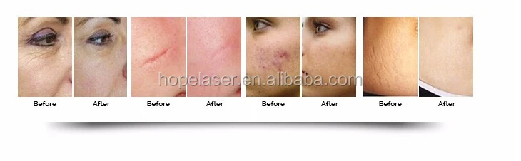 USA Coherent Metal Tube Medical RFco2 fractional laser cosmetic laser machine HP07