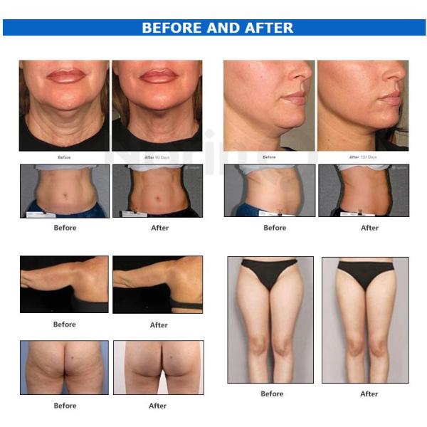 40KHZ Cavitation Body Slimming Machine For Fat Freeze Cryolipolysis Treatment